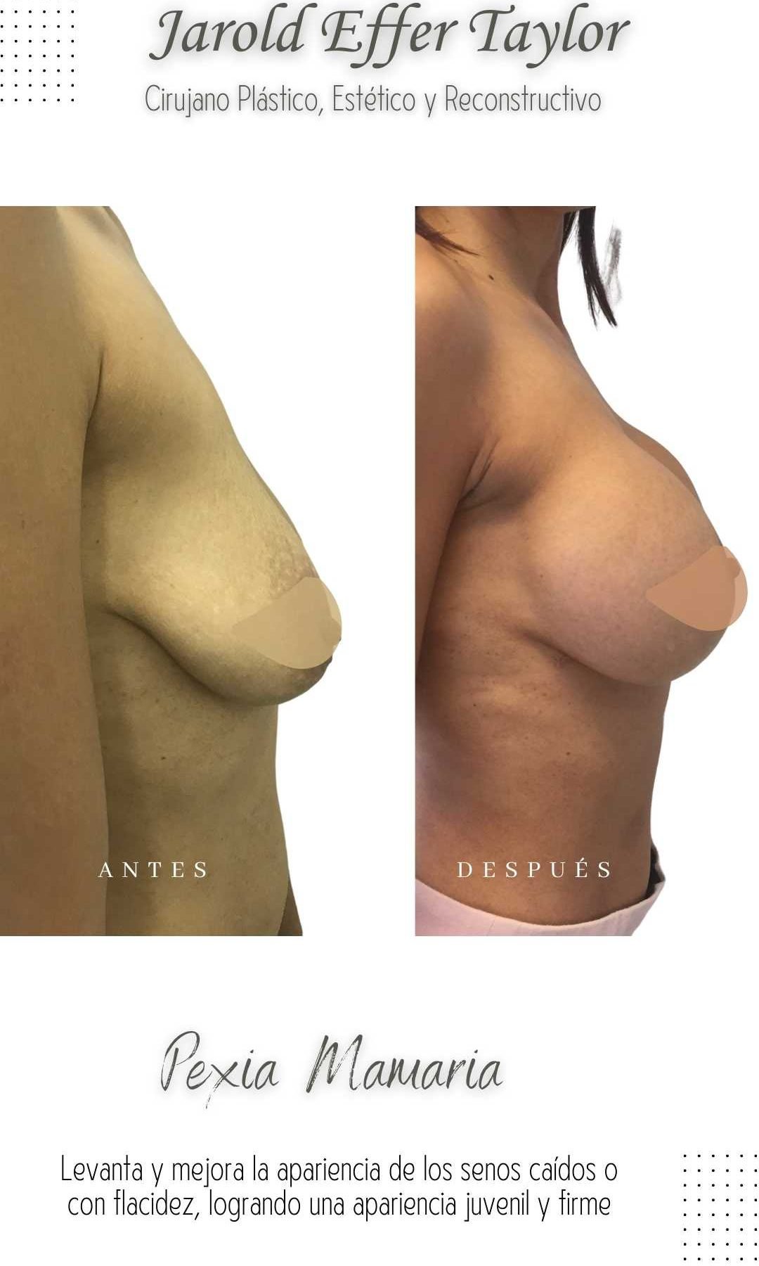 Cirugia-plastica-Cirujano-Plastico-Jarold-Effer-Taylor-procedimiento-mamoplastia-pexia-mamaria-antes-y-despues-2